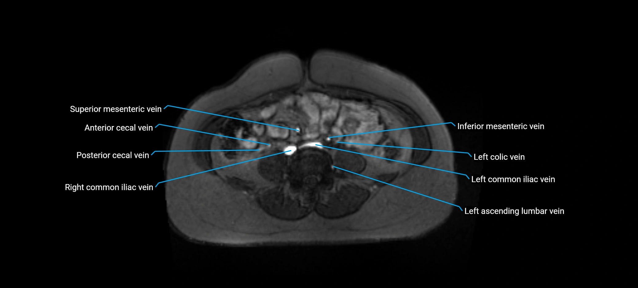 MRV abdomen pelvis & lower limb axial cross sectional anatomy labelled MRI image 117 (1).webp